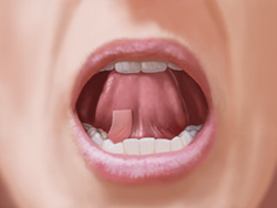 Suboxone Suboxone addiction